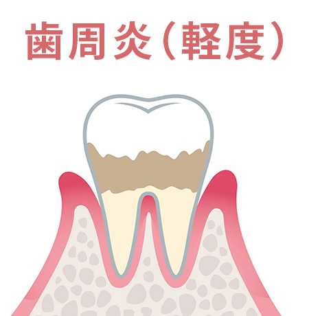 歯周炎(軽度)