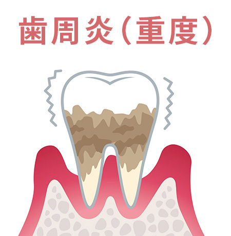 歯周炎(重度)